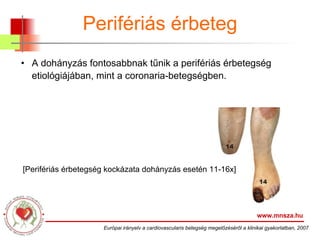 Perifériás érbeteg A dohányzás fontosabbnak tűnik a perifériás érbetegség etiológiájában, mint a coronaria-betegségben.   www.mnsza.hu Európai irányelv a cardiovascularis betegség megelőzéséről a klinikai gyakorlatban, 2007 [Perifériás érbetegség kockázata dohányzás esetén 11-16x] 