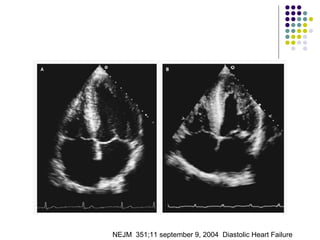 NEJM  351;11 september 9, 2004  Diastolic Heart Failure 