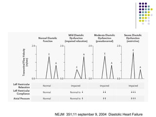 NEJM  351;11 september 9, 2004  Diastolic Heart Failure 
