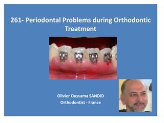 261- Periodontal Problems during Orthodontic
Treatment
Olivier Oussama SANDID
Orthodontist - France
 