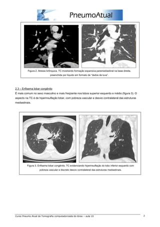 Figura 2. Atresia brônquica. TC mostrando formação expansiva paramediastinal na base direita, 
preenchida por líquido em formato de “dedos de luva”. 
2.3 – Enfisema lobar congênito 
É mais comum no sexo masculino e mais freqüente nos lobos superior esquerdo e médio (figura 3). O 
aspecto na TC é de hiperinsuflação lobar, com pobreza vascular e desvio contralateral das estruturas 
mediastinais. 
Figura 3. Enfisema lobar congênito. TC evidenciando hiperinsuflação do lobo inferior esquerdo com 
pobreza vascular e discreto desvio contralateral das estruturas mediastinais. 
Curso Pneumo Atual de Tomografia computadorizada do tórax – aula 10 2 
 