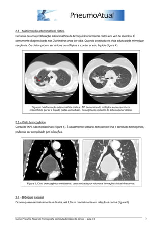 2.4 – Malformação adenomatóide cística 
Consiste de uma proliferação adenomatóide de bronquíolos formando cistos em vez de alvéolos. É 
comumente diagnosticada nos 2 primeiros anos de vida. Quando detectada na vida adulta pode mimetizar 
neoplasia. Os cistos podem ser únicos ou múltiplos e conter ar e/ou líquido (figura 4). 
Figura 4. Malformação adenomatóide cística. TC demonstrando múltiplos espaços císticos 
preenchidos por ar e líquido (setas vermelhas), no segmento posterior do lobo superior direito. 
2.5 – Cisto broncogênico 
Cerca de 90% são mediastinais (figura 5). É usualmente solitário, tem parede fina e conteúdo homogêneo, 
podendo ser complicado por infecções. 
Figura 5. Cisto broncogênico mediastinal, caracterizado por volumosa formação cística infracarinal. 
2.6 – Brônquio traqueal 
Ocorre quase exclusivamente à direita, até 2,0 cm cranialmente em relação à carina (figura 6). 
Curso Pneumo Atual de Tomografia computadorizada do tórax – aula 10 3 
 