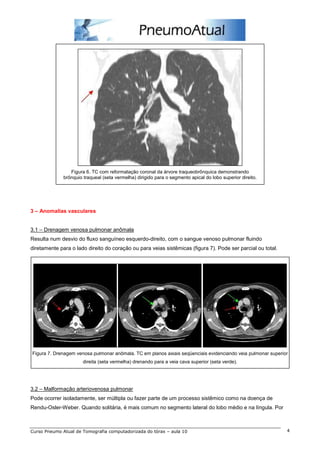 Figura 6. TC com reformatação coronal da árvore traqueobrônquica demonstrando 
brônquio traqueal (seta vermelha) dirigido para o segmento apical do lobo superior direito. 
3 – Anomalias vasculares 
3.1 – Drenagem venosa pulmonar anômala 
Resulta num desvio do fluxo sanguíneo esquerdo-direito, com o sangue venoso pulmonar fluindo 
diretamente para o lado direito do coração ou para veias sistêmicas (figura 7). Pode ser parcial ou total. 
Figura 7. Drenagem venosa pulmonar anômala. TC em planos axiais seqüenciais evidenciando veia pulmonar superior 
direita (seta vermelha) drenando para a veia cava superior (seta verde). 
3.2 – Malformação arteriovenosa pulmonar 
Pode ocorrer isoladamente, ser múltipla ou fazer parte de um processo sistêmico como na doença de 
Rendu-Osler-Weber. Quando solitária, é mais comum no segmento lateral do lobo médio e na língula. Por 
Curso Pneumo Atual de Tomografia computadorizada do tórax – aula 10 4 
 