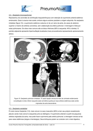 4.2 – Seqüestro broncopulmonar 
Representa uma anomalia da ramificação traqueobrônquica com retenção do suprimento arterial sistêmico 
embrionário. Esta é a teoria mais aceita, embora alguns autores postulem a origem adquirida. No seqüestro 
intralobar (figura 10), o suprimento sistêmico costuma vir de um ramo da aorta, de vasos do abdome 
superior e mesmo de artérias coronárias, sem colaboração da artéria pulmonar. A drenagem é feita por 
veias pulmonares. Os sítios mais comuns são os lobos inferiores (60% à esquerda; 40% à direita). O 
pulmão adjacente apresenta hiperinsuflação localizada (mais provavelmente representando aprisionamento 
aéreo). 
Figura 10. Seqüestro pulmonar intralobar. TC após injeção venosa de meio de contraste evidenciando 
consolidação no lobo inferior esquerdo (seta vermelha) suprida por duas artérias sistêmicas (seta verde) 
originadas da aorta descendente. 
4.3 – Seqüestro extralobar 
É muito menos freqüente (1:6), mais comum no sexo masculino (80%) e tem seu próprio revestimento 
pleural, sendo mais comum à esquerda junto ao diafragma. O suprimento arterial é a partir de pequenas 
artérias originadas da aorta, mas pode haver suprimento pela artéria pulmonar; a drenagem venosa se faz 
para veias sistêmicas (ázigos e hemiázigos). Seus brônquios podem se conectar com o trato digestivo. 
Curso Pneumo Atual de Tomografia computadorizada do tórax – aula 10 6 
 