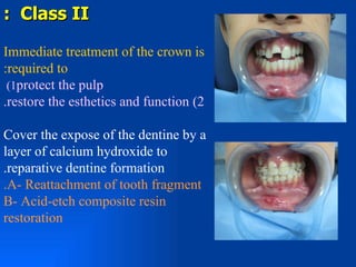 : Class II

Immediate treatment of the crown is
:required to
 (1protect the pulp
.restore the esthetics and function (2

Cover the expose of the dentine by a
layer of calcium hydroxide to
.reparative dentine formation
.A- Reattachment of tooth fragment
B- Acid-etch composite resin
restoration
 