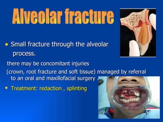 • Small fracture through the alveolar
   process.
there may be concomitant injuries
(crown, root fracture and soft tissue) managed by referral
  to an oral and maxillofacial surgery .
• Treatment: redaction , splinting
 