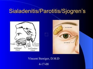 Sialadenitis/Parotitis/Sjogren’s   Vincent Steniger, D.M.D  4-17-08 