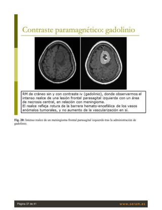 Fig. 20: Intenso realce de un meningioma frontal parasagital izquierdo tras la administración de
gadolinio.
Página 37 de 41
 