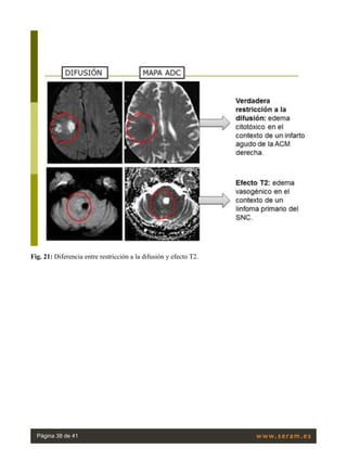 Fig. 21: Diferencia entre restricción a la difusión y efecto T2.
Página 38 de 41
 