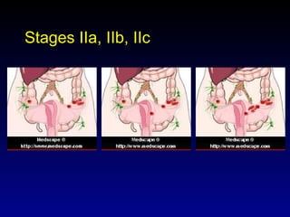 Stages IIa, IIb, IIc 