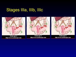 Stages IIIa, IIIb, IIIc 