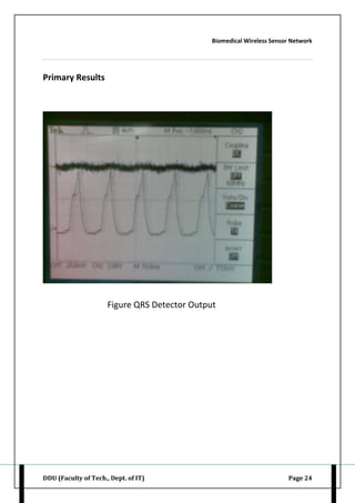 Biomedical Wireless Sensor Network
DDU (Faculty of Tech., Dept. of IT) Page 24
Primary Results
Figure QRS Detector Output
 