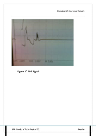 Biomedical Wireless Sensor Network
DDU (Faculty of Tech., Dept. of IT) Page 26
Figure 1st
ECG Signal
 