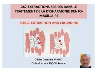 Olivier Oussama SANDID
Orthodontist – SQODF- France
267-EXTRACTIONS SERIEES DANS LE
TRAITEMENT DE LA DYSHARMONIE DENTO-
MAXILLAIRE
SERIAL EXTRACTION AND CROWDING
 