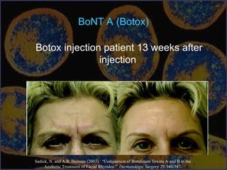 BoNT A (Botox)
Botox injection patient 13 weeks after
injection
Sadick, N. and A.R. Herman (2003). “Comparison of Botulinum Toxins A and B in the
Aesthetic Treatment of Facial Rhytides.” Dermatologic Surgery 29:340-347.
 