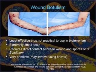 Wound Botulism
• Least effective thus not practical to use in bioterrorism
• Extremely small scale
• Requires direct contact between wound and spores of C.
Botulinum
• Very primitive (may involve using knives)
Jermann M, Hiersemenzel LP, Waespe W. Drug-dependent patient with multiple
cutaneous abscesses and wound botulism. Schweiz Med Wochenschr 1999,
129:1467
 
