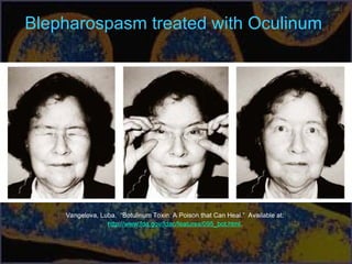 Blepharospasm treated with Oculinum
Vangelova, Luba. “Botulinum Toxin: A Poison that Can Heal.” Available at:
http://www.fda.gov/fdac/features/095_bot.html.
 