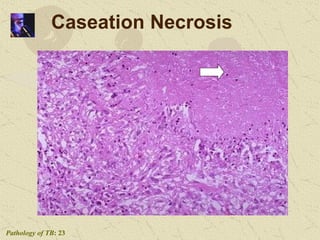 Caseation Hitopath Clinical representations of Tuberculosis | PPTX