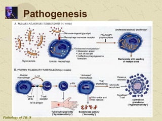 Clinical representations of Tuberculosis | PPTX