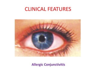 Allergic Rhinitis | PPTX