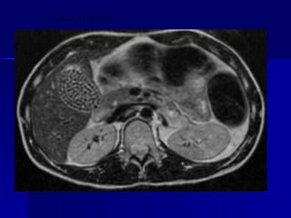 COLELITIASIS –  RESONANCIA MAGNÉTICA 