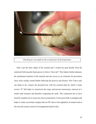 Checking for even depth on the occlusal part of the preparation.



   After I got the basic shape of the occlusal part I extend my prep facially from the

central pit following the facial groove to form a “dove tail”. This feature further enhances

the mechanical retention of the material and also serves as an extension for prevention

since caries usually extend further following the grooves and fissures. Now I have only

one thing to do: connect the proximal box with the occlusal prep by which I create

reverse “S” that helps to circumvent the cusps and prevent unnecessary removal of a

sound tooth structure and therefore weakening the tooth. This connection has to have

smooth, rounded curves to prevent stress accumulation. It also gives bulk to amalgam and

helps to create cavosurface margins that are 90° (due to the angulation of enamel rods at

this area this ensures removal of unsupported enamel rods).




                                                                                         10
 