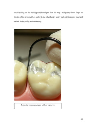 avoid pulling out the freshly packed amalgam from the prep I will put my index finger on

the top of the proximal box and with the other hand I gently pull out the matrix band and

exhale if everything went smoothly.




        Removing excess amalgam with an explorer.




                                                                                      13
 