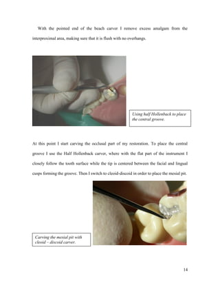 With the pointed end of the beach carver I remove excess amalgam from the

interproximal area, making sure that it is flush with no overhangs.




                                                          Using half Hollenback to place
                                                          the central groove.




At this point I start carving the occlusal part of my restoration. To place the central

groove I use the Half Hollenback carver, where with the flat part of the instrument I

closely follow the tooth surface while the tip is centered between the facial and lingual

cusps forming the groove. Then I switch to cleoid-discoid in order to place the mesial pit.




 Carving the mesial pit with
 cleoid – discoid carver.




                                                                                         14
 