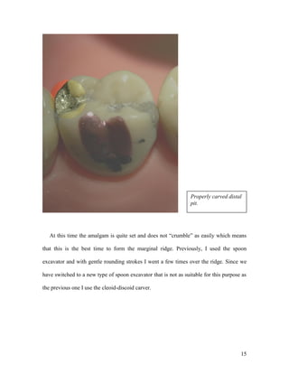 Properly carved distal
                                                                 pit.




   At this time the amalgam is quite set and does not “crumble” as easily which means

that this is the best time to form the marginal ridge. Previously, I used the spoon

excavator and with gentle rounding strokes I went a few times over the ridge. Since we

have switched to a new type of spoon excavator that is not as suitable for this purpose as

the previous one I use the cleoid-discoid carver.




                                                                                       15
 