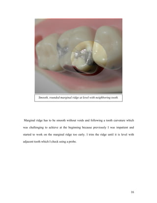 Smooth, rounded marginal ridge at level with neighboring tooth.




Marginal ridge has to be smooth without voids and following a tooth curvature which

was challenging to achieve at the beginning because previously I was impatient and

started to work on the marginal ridge too early. I trim the ridge until it is level with

adjacent tooth which I check using a probe.




                                                                                     16
 