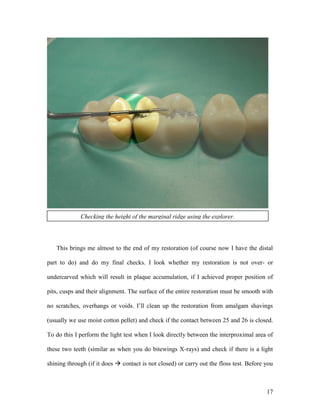 Checking the height of the marginal ridge using the explorer.




   This brings me almost to the end of my restoration (of course now I have the distal

part to do) and do my final checks. I look whether my restoration is not over- or

undercarved which will result in plaque accumulation, if I achieved proper position of

pits, cusps and their alignment. The surface of the entire restoration must be smooth with

no scratches, overhangs or voids. I’ll clean up the restoration from amalgam shavings

(usually we use moist cotton pellet) and check if the contact between 25 and 26 is closed.

To do this I perform the light test when I look directly between the interproximal area of

these two teeth (similar as when you do bitewings X-rays) and check if there is a light

shining through (if it does  contact is not closed) or carry out the floss test. Before you



                                                                                         17
 