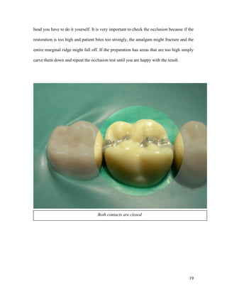 head you have to do it yourself. It is very important to check the occlusion because if the

restoration is too high and patient bites too strongly, the amalgam might fracture and the

entire marginal ridge might fall off. If the preparation has areas that are too high simply

carve them down and repeat the occlusion test until you are happy with the result.




                                    Both contacts are closed.




                                                                                        19
 