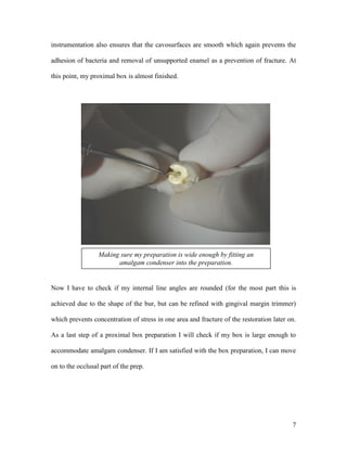 instrumentation also ensures that the cavosurfaces are smooth which again prevents the

adhesion of bacteria and removal of unsupported enamel as a prevention of fracture. At

this point, my proximal box is almost finished.




                  Making sure my preparation is wide enough by fitting an
                        amalgam condenser into the preparation.


Now I have to check if my internal line angles are rounded (for the most part this is

achieved due to the shape of the bur, but can be refined with gingival margin trimmer)

which prevents concentration of stress in one area and fracture of the restoration later on.

As a last step of a proximal box preparation I will check if my box is large enough to

accommodate amalgam condenser. If I am satisfied with the box preparation, I can move

on to the occlusal part of the prep.




                                                                                          7
 
