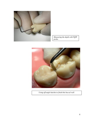 Measuring the depth with PQW
                    probe.




Using off angle hatchet to finish the buccal wall.




                                                     8
 