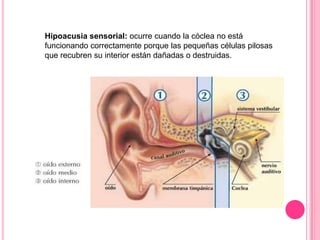Hipoacusia sensorial: ocurre cuando la cóclea no está
funcionando correctamente porque las pequeñas células pilosas
que recubren su interior están dañadas o destruidas.

 