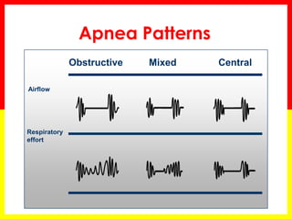 Apnea Patterns
Obstructive Mixed Central
Airflow
Respiratory
effort
 