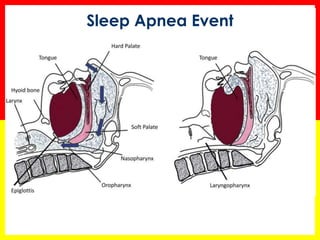 Sleep Apnea Event
 