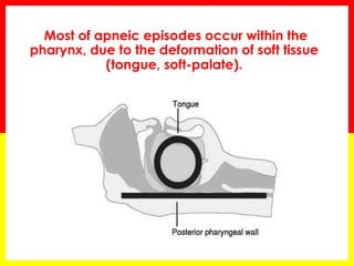 Most of apneic episodes occur within the
pharynx, due to the deformation of soft tissue
(tongue, soft-palate).
 
