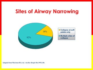 Sites of Airway Narrowing
Adapted from Morrison DL et al. Am Rev Respir Dis 1993;148.
Collapse at soft
palate only
Multiple sites of
collapse
18%
82%
 