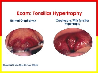 Exam: Tonsillar Hypertrophy
Shepard JW Jr et al. Mayo Clin Proc 1990;65.
Oropharynx With Tonsillar
Hypertrophy
Normal Oropharynx
 