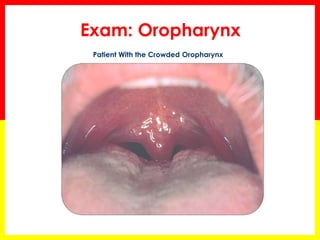 Exam: Oropharynx
Patient With the Crowded Oropharynx
 