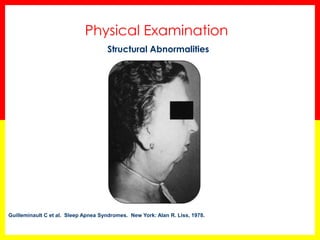 Physical Examination
Guilleminault C et al. Sleep Apnea Syndromes. New York: Alan R. Liss, 1978.
Structural Abnormalities
 
