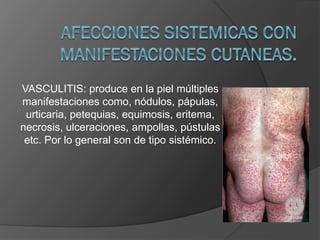 VASCULITIS: produce en la piel múltiples
manifestaciones como, nódulos, pápulas,
urticaria, petequias, equimosis, eritema,
necrosis, ulceraciones, ampollas, pústulas
etc. Por lo general son de tipo sistémico.

 