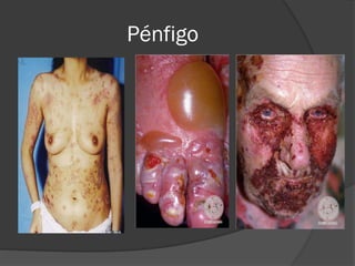 Pénfigo

 