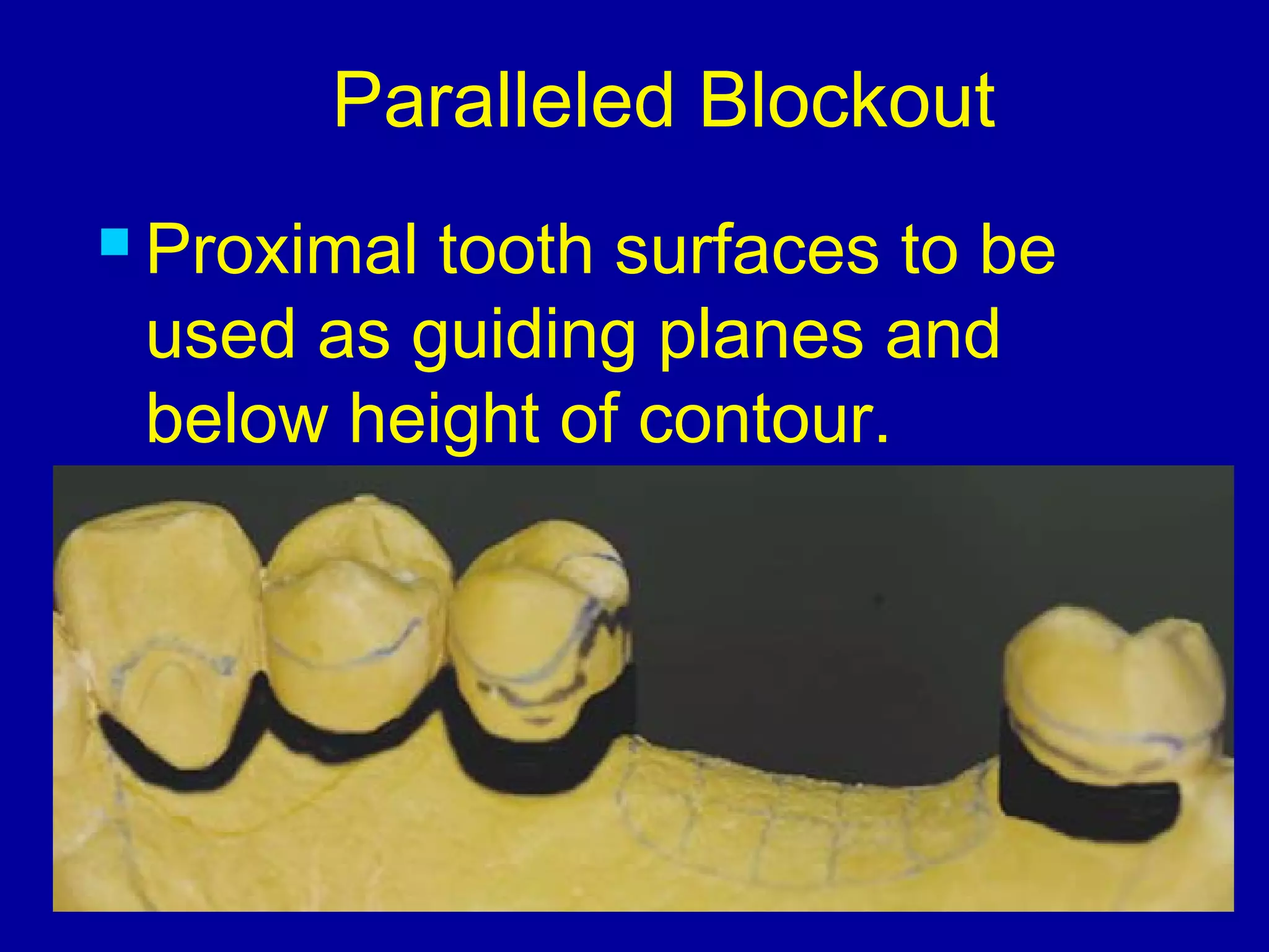 Paralleled Blockout
 Proximal tooth surfaces to be
used as guiding planes and
below height of contour.
 