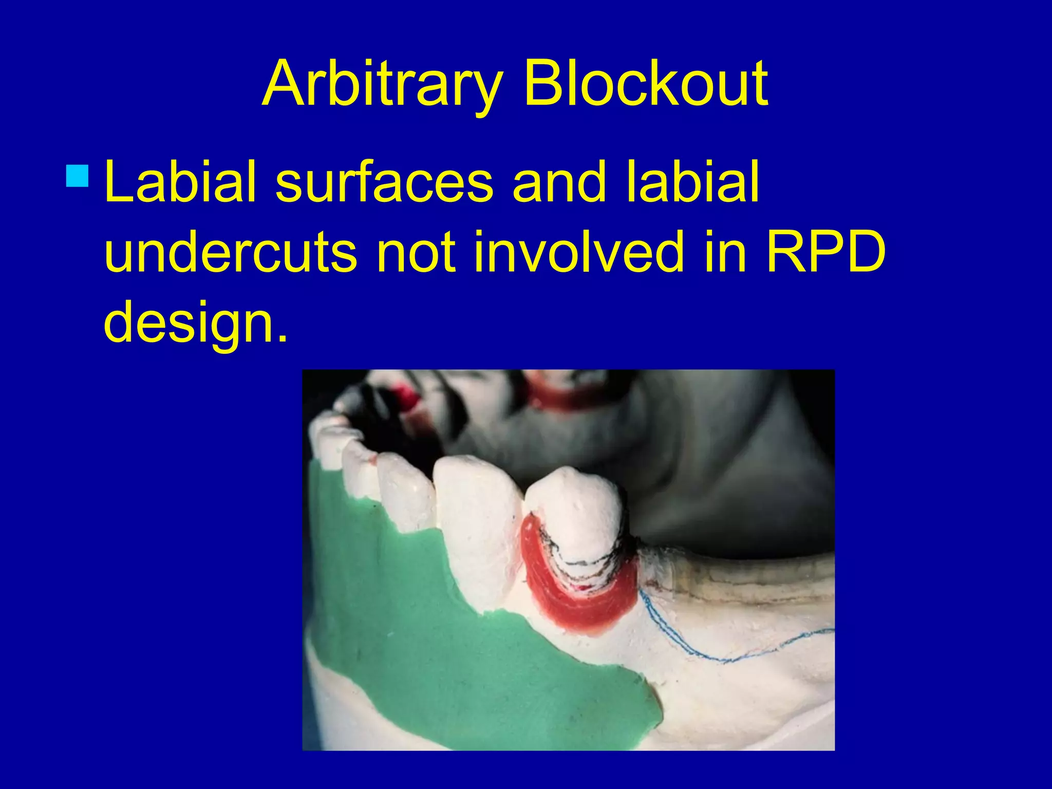 Arbitrary Blockout
 Labial surfaces and labial
undercuts not involved in RPD
design.
 