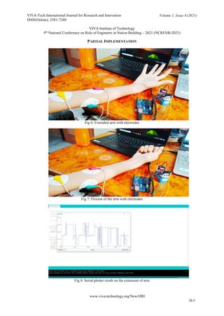 Prosthetic Arm for Amputees | PDF