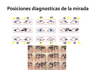 RS RS
RS OI OI RS
RM RM RL
RI RI
RI OS OS RI
Posiciones diagnosticas de la mirada
 