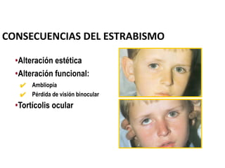 •Alteración estética
•Alteración funcional:
✔ Ambliopía
✔ Pérdida de visión binocular
•Tortícolis ocular
CONSECUENCIAS DEL ESTRABISMO
 