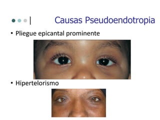 Causas Pseudoendotropia
• Pliegue epicantal prominente
• Hipertelorismo
 